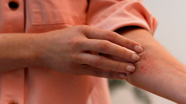 Укусы насекомых 