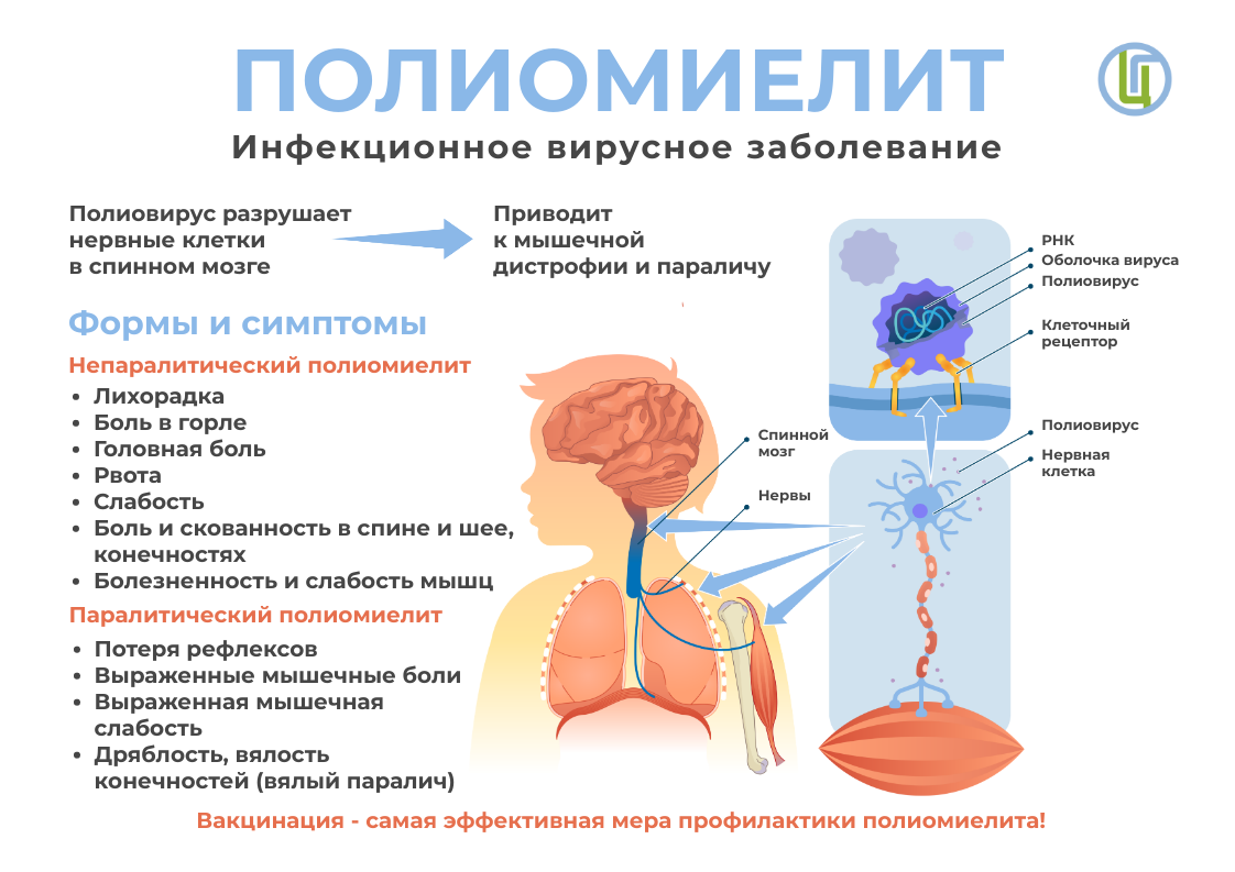 Полиомиелит