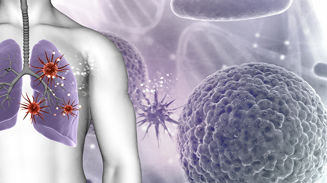 Пневмококковая инфекция