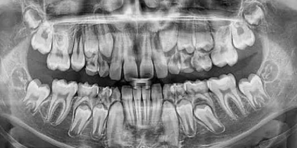 Зачатки зубов в челюсти